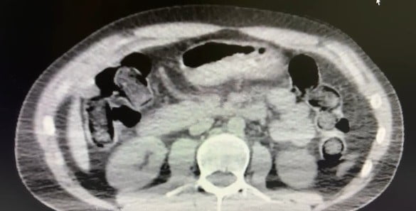 NEVŞEHİR'DE, POLİS EKİPLERİ TARAFINDAN DÜZENLENEN OPERASYONDA 'YUTMA YÖNTEMİ' İLE MİDELERİNDE...