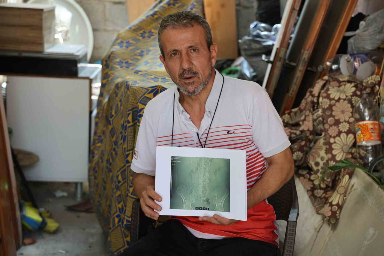 ADANA’DA İŞ KAZASI GEÇİRDİKTEN SONRA BELİNDEN AMELİYAT OLAN MEHMET GÜR, BELİNDE PANÇ UNUTULDUĞU...