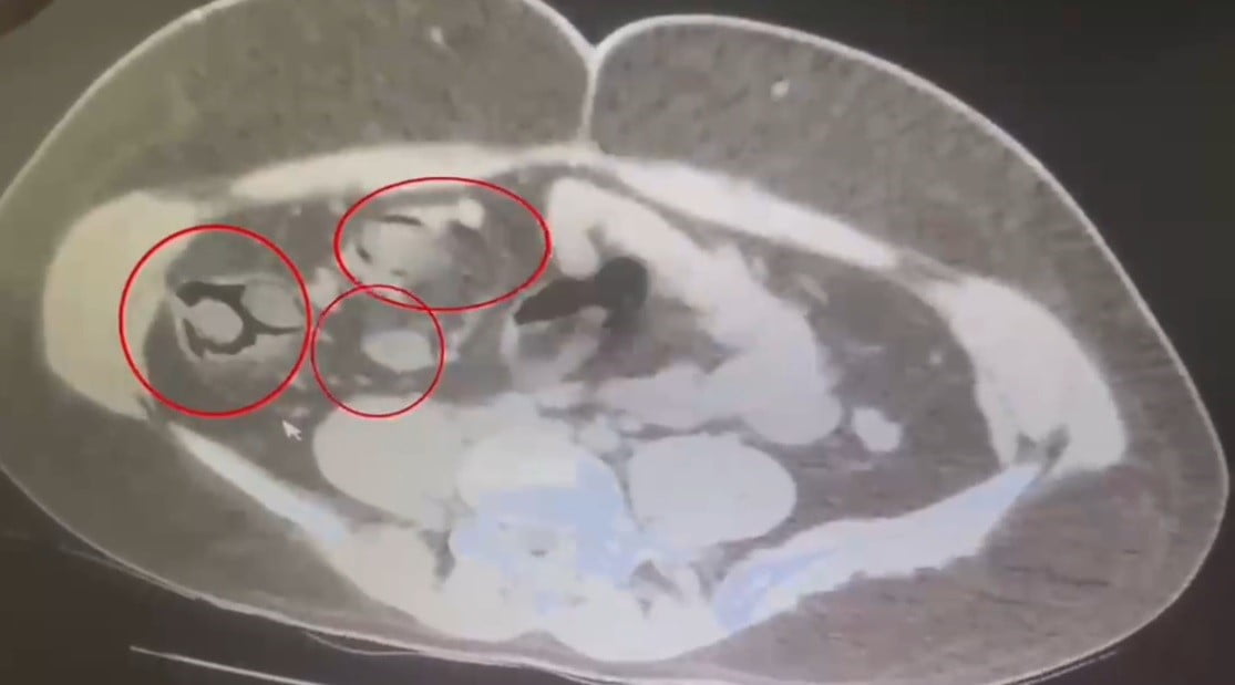 ŞAHSIN İÇ BEDEN MUAYENESİNDE 76 PARÇA HALİNDE TOPLAM 571,91 GRAM METAMFETAMİN ELE...