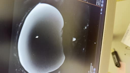 Türkiye'ye obezite cerrahisi için geldi, tek operasyonda 5 farklı ameliyat geçirdi