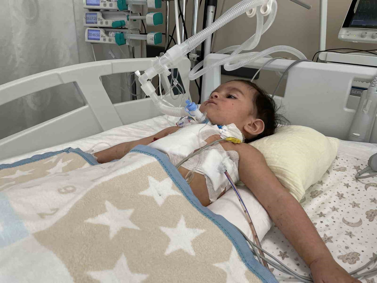 1 YAŞINDAKİ CABİR ATA KIRAN'IN AKCİĞERİNDEN CEVİZ ÇIKARTILDI